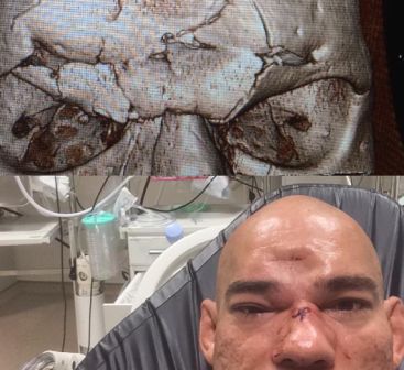 CrA?nio afundado. Lutador brasileiro sofre golpe quase fatal em luta no bellator